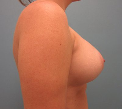 Breast Augmentation