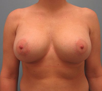 Breast Augmentation