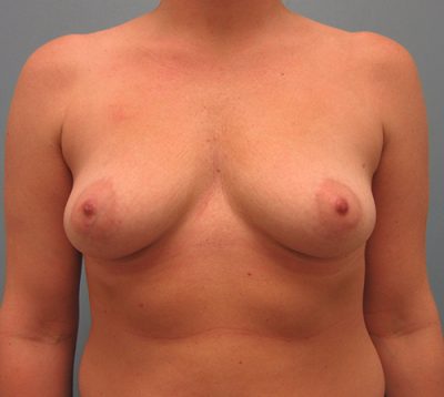 Breast Augmentation