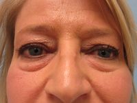 Upper and Lower Blepharoplasty