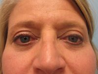 Upper and Lower Blepharoplasty