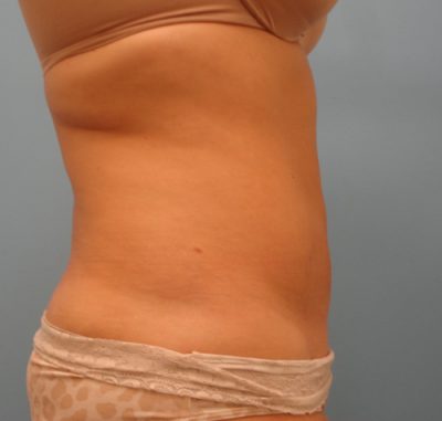 Liposuction