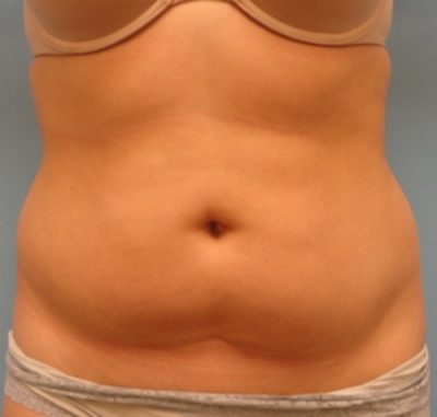 Liposuction Results Baton Rouge