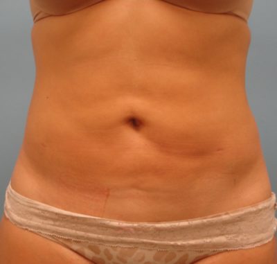 Liposuction