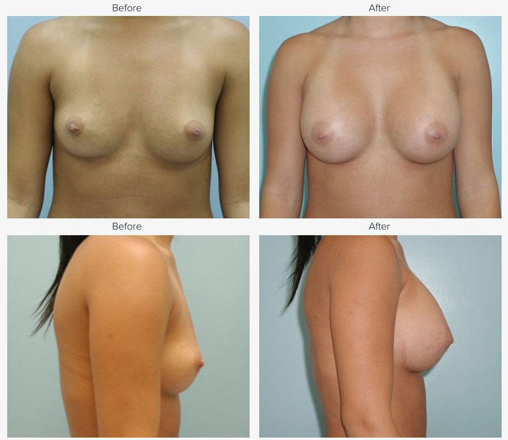 Breast Augmentation Before and After