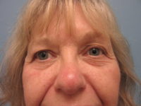 Upper and Lower Blepharoplasty