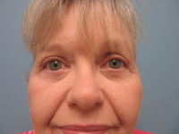 Upper and Lower Blepharoplasty