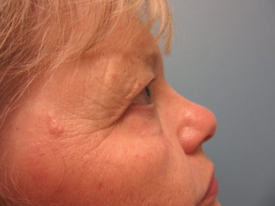 Upper and Lower Blepharoplasty