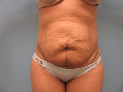 Abdominoplasty