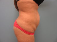 Abdominoplasty