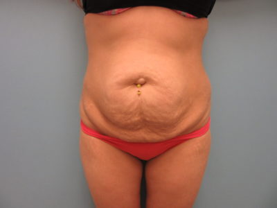 Abdominoplasty