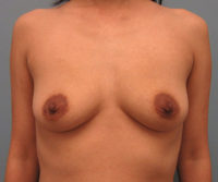 Breast Augmentation