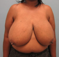 Breast Reduction