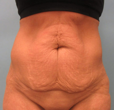 Abdominoplasty