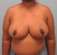 Breast Reduction