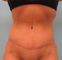 Abdominoplasty