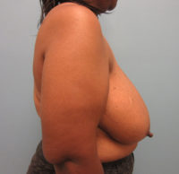 Breast Reduction