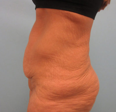 Abdominoplasty