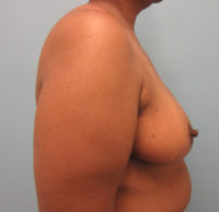 Breast Reduction