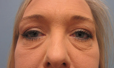 Upper and Lower Blepharoplasty