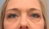 Upper and Lower Blepharoplasty