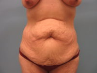 Abdominoplasty