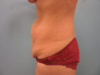 Abdominoplasty