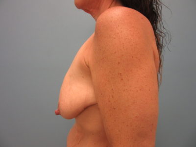 Breast Lift