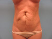 Abdominoplasty