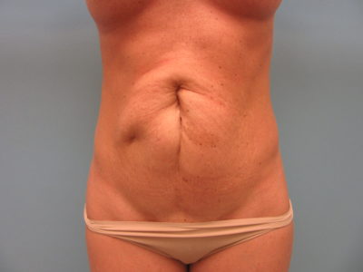 Abdominoplasty