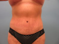 Abdominoplasty