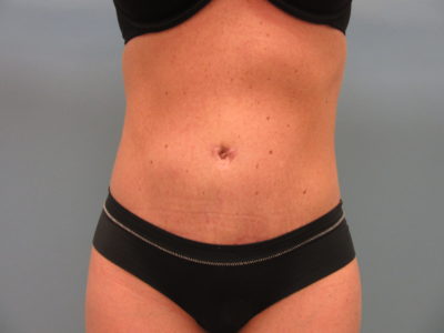 Abdominoplasty