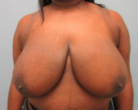 Breast Reduction