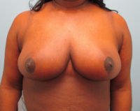 Breast Reduction