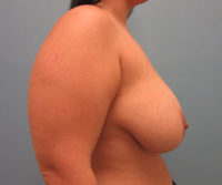 Breast Reduction