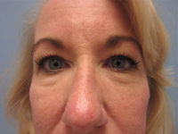 Upper and Lower Blepharoplasty