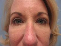 Upper and Lower Blepharoplasty