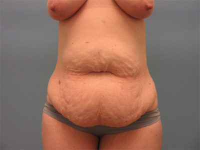 Abdominoplasty