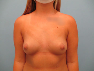 Breast Augmentation