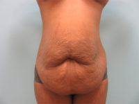 Abdominoplasty