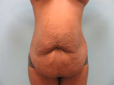 Abdominoplasty