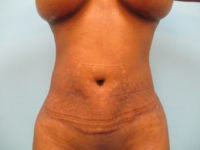 Abdominoplasty