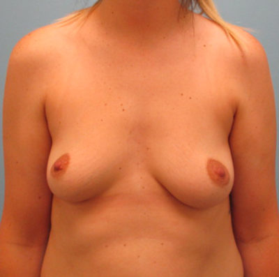 Breast Augmentation