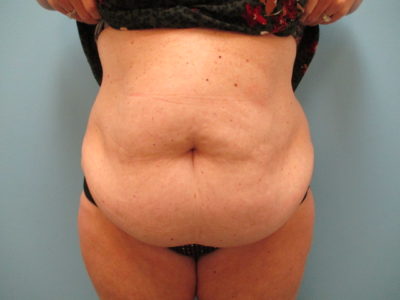 Abdominoplasty