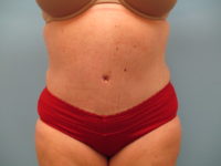 Abdominoplasty