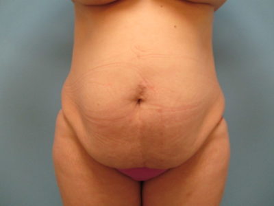 Abdominoplasty