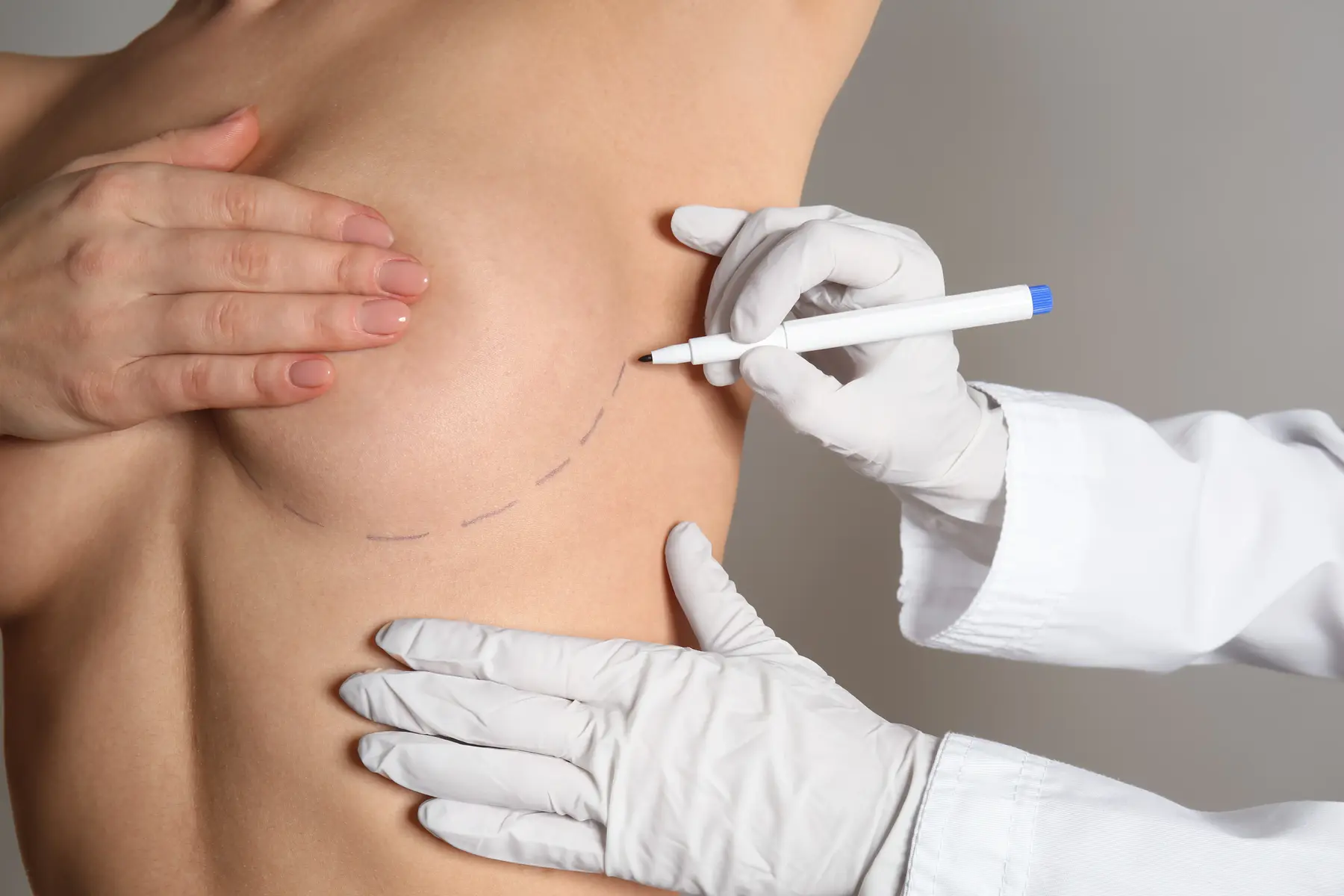 Surgeon marking patient for breast augmentation procedure.